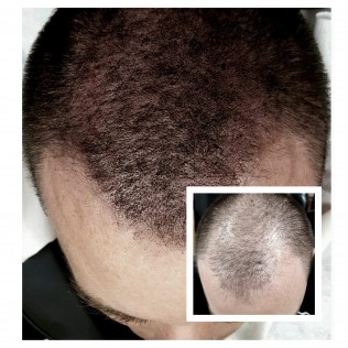 Scalp International Hairlines cover